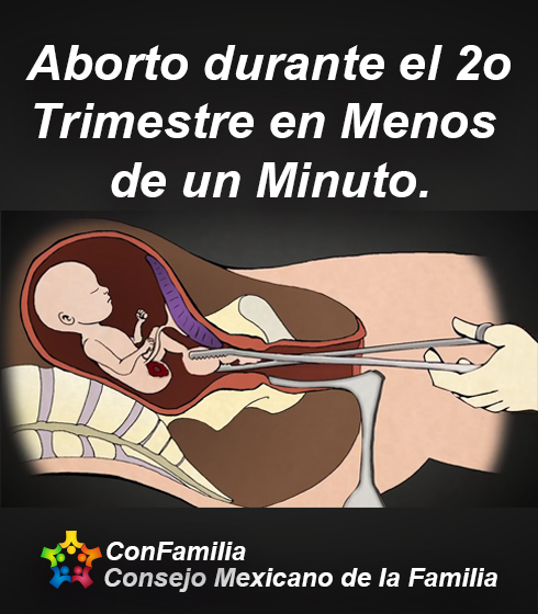Aborto durante el 2o Trimestre en Menos de un Minuto.